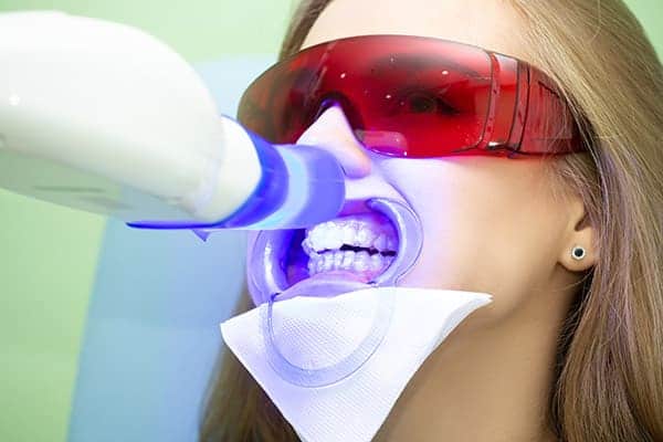 Laser teeth whitening treatments Basingstoke