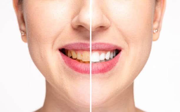 Teeth Whitening Milton Keynes Basingstoke