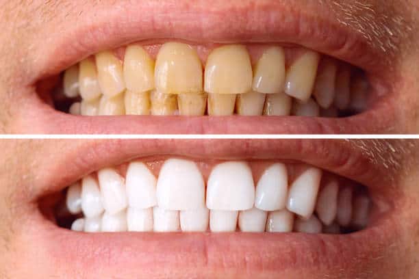 Laser White For Ever Bright – Get a Brighter, Whiter Smile with LA Teeth Whitening Basingstoke