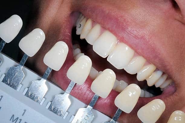 Get Natural and Stunning Smile with Teeth Whitening Results from LA Teeth Whitening Basingstoke