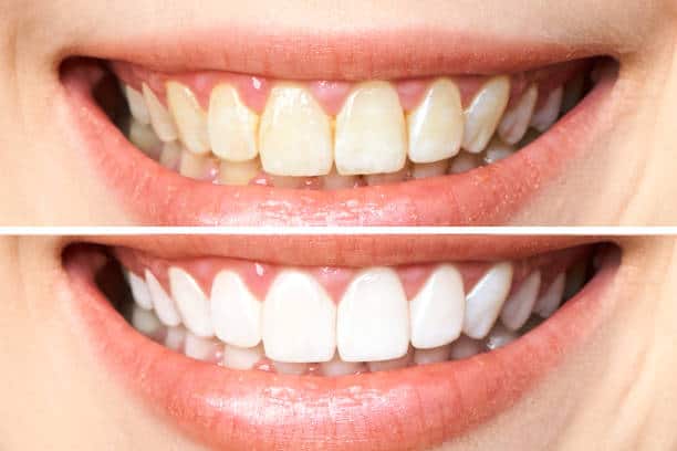 Achieve a Dazzling Smile for Your Special Day: A Guide to Wedding Teeth Whitening Basingstoke