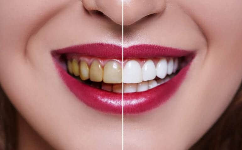 Teeth Whitening Ascot Windsor Basingstoke