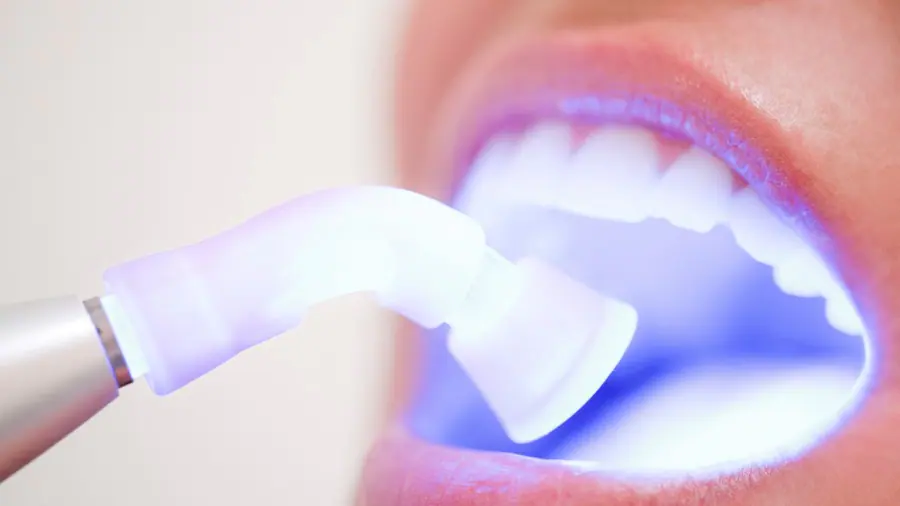 Teeth Whitening Aylesbury Basingstoke