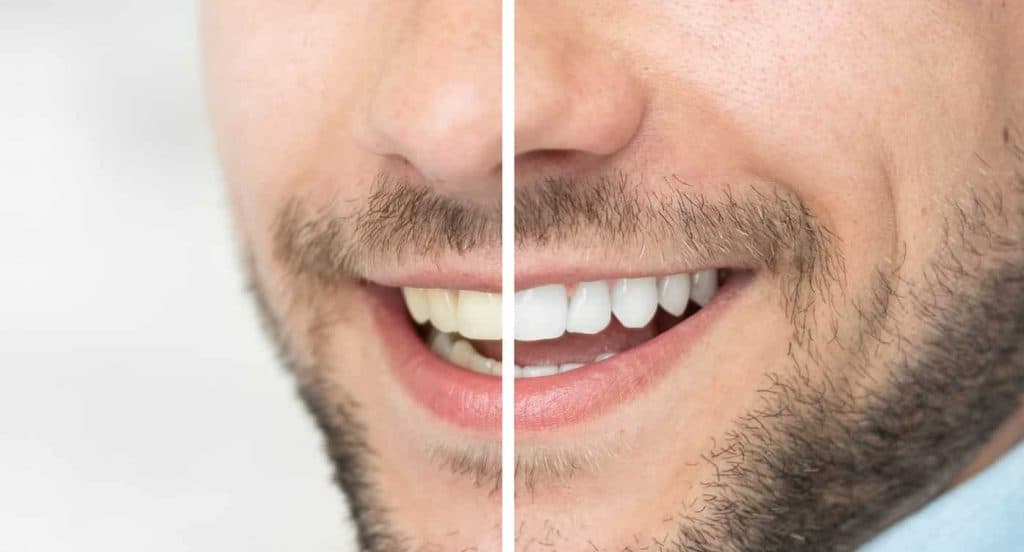 Teeth Whitening Bedfordshire Basingstoke