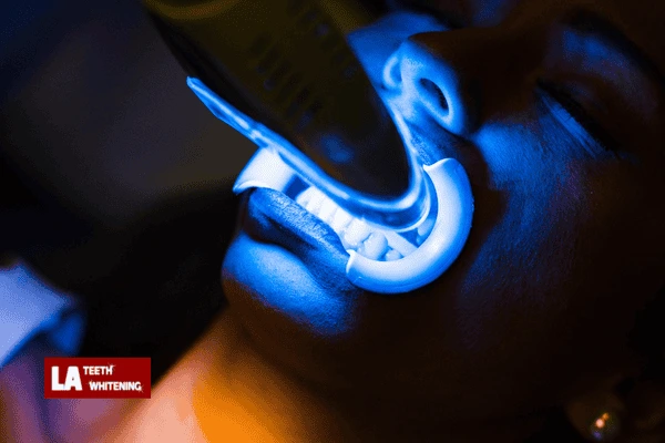 Is Laser Whitening Worth It? Basingstoke