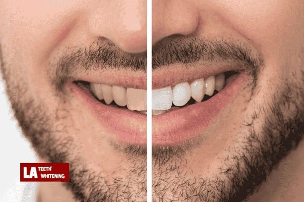 Is Laser Whitening Better Than Bleaching? Basingstoke